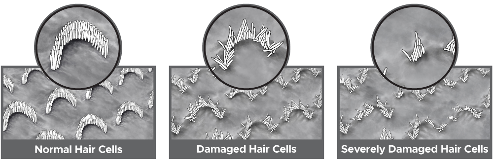 normal and damaged inner ear cochlea hair cells