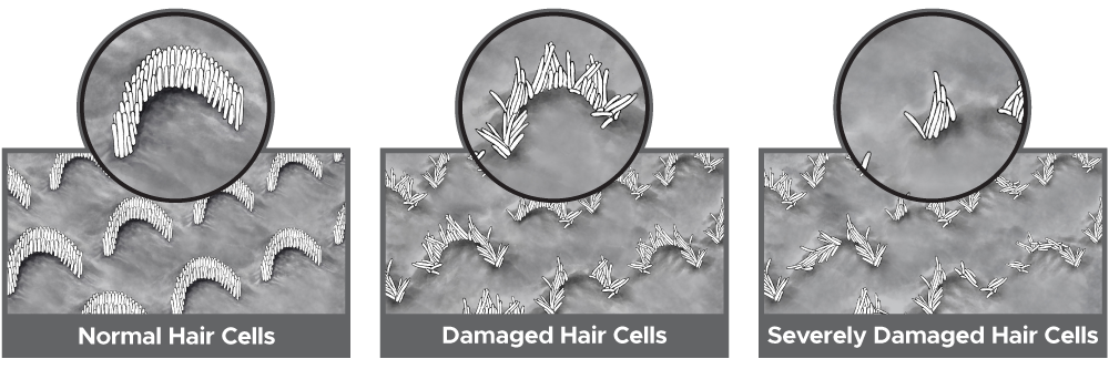 normal and damaged inner ear cochlea hair cells