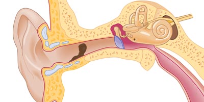 ear canal showing a wax accumulation that requires removal for proper function of a hearing aid
